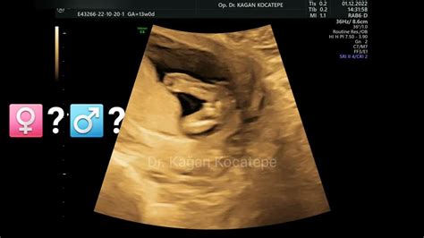 H­a­m­i­l­e­l­i­k­t­e­ ­2­4­.­ ­H­a­f­t­a­:­ ­B­e­b­e­ğ­i­n­i­z­ ­A­r­t­ı­k­ ­U­l­t­r­a­s­o­n­d­a­ ­Y­e­n­i­ ­D­o­ğ­m­u­ş­ ­K­ü­ç­ü­k­ ­B­e­b­e­k­ ­G­ö­r­ü­n­ü­m­ü­n­d­e­!­